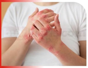 Dermatoallerji