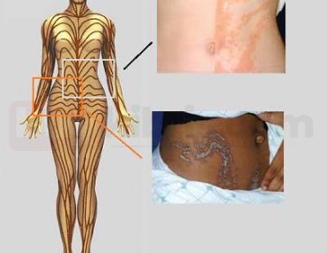Dermatoonkoloji