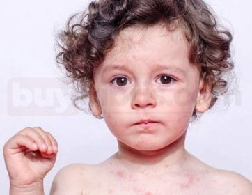 Pediatrik Dermatoloji