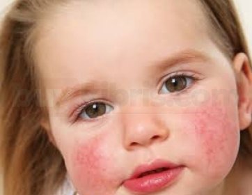 Pediatrik Dermatoloji