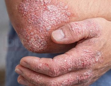 Psoriasis (Sedef Hastalığı)