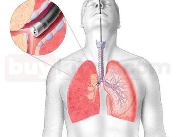 Bronş Plastiği