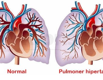 İnterstisyel Hastalıklar, Pulmoner Hipertansiyon