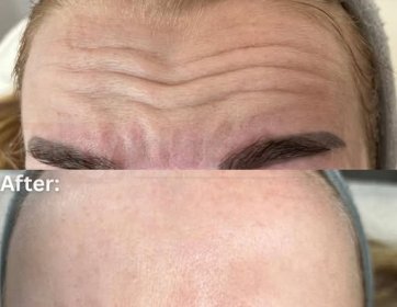 Botox Öncesi & Sonrası Mükemmel Dokunuş