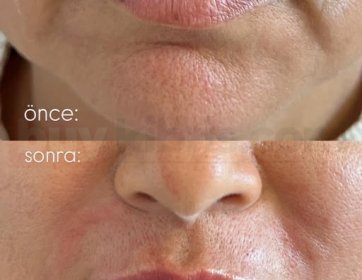 Dolgu ile birkaç bölgede yapılan küçük bir dokunuş