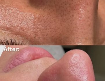 Tıkanmış gözeneklere elveda, ışıltılı bir cilde merhaba! ✨