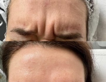 Yazın botoks olur mu?