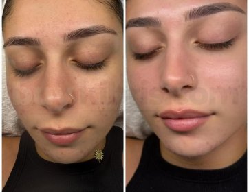 Haydi gençler, yeni döneme canlı, temiz ve siyah noktalardan arınmış bir cilt ile başlamak ister misiniz? 🌿💆‍♀️