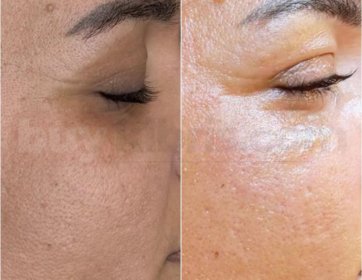 Epirenew Cilt Tonu Eşitleme Protokolü ile Işıltılı ve Eşit Bir Ten!