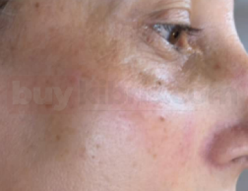 EPIRENEW CİLT TONU EŞİTLEME PROTOKOLÜ