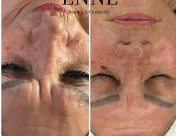 ENNE Beauty | Saten Yüz Germe