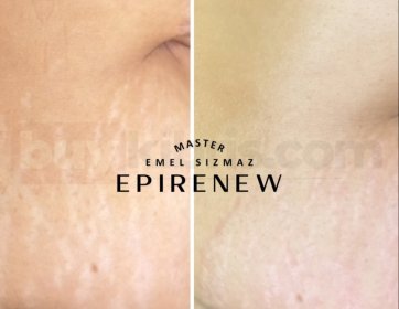 Tek seansta cildin yenilenmesini hisset,çatlak görünümündeki inanılmaz farkı gör!