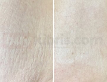 Çatlaklarla vedalaşmak bu kadar hızlı olamaz derlerdi… Biz başardık!”