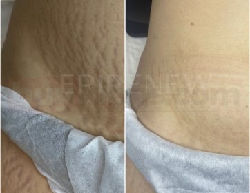 Hamilelik mucize… Ama geride kalan izler kader değil!