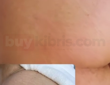 ✨ Vücut Çatlakları Artık Sorun Değil! ✨