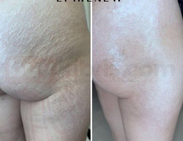 ✨ Çatlaklar artık kaderiniz değil!