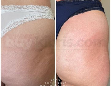 Epirenew Vücut Çatlak Protokolü ile Tek Seans Sonucumuz!