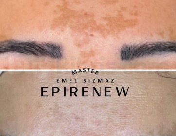 Sadece 1 Seansta Gözle Görülür Canlanma!