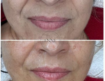 Gülümsemenin izleri hayatın en güzel armağanı…