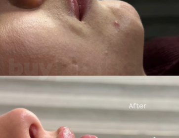 Doğal Dudak Dolgusu