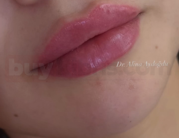 Dolgun ve Doğal Dudak Görünümü