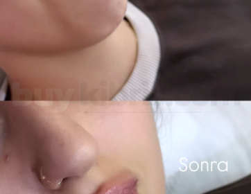 Doğal Hacim ve Dudak Şekillendirme