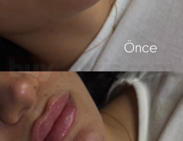 Dudak Hacim Artırma ve Net Kontur