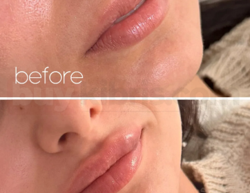 Profil Uyumlu Dudak Dolgusu