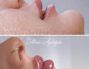 Yüzle Uyumlu Dudak Estetiği