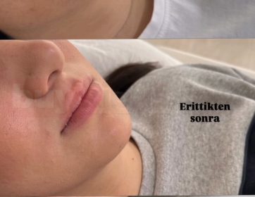 Dolgu Eritme ve Yeniden Şekillendirme