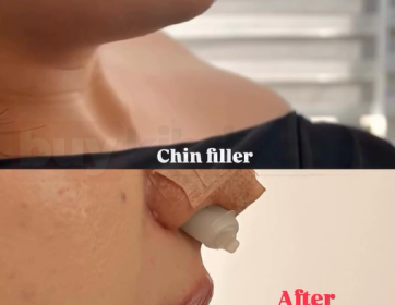 Çene Dolgusu ile Profil Dengeleme