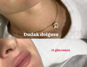 Kalıcı Etki ve Doğal Dudak Dolgusu