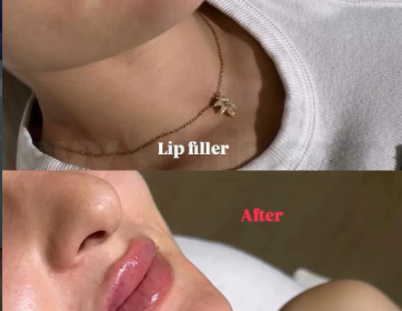 Doğal Dudak Dolgusu Sonucu