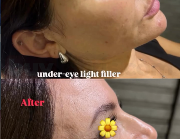 Göz Altı Işık Dolgusu