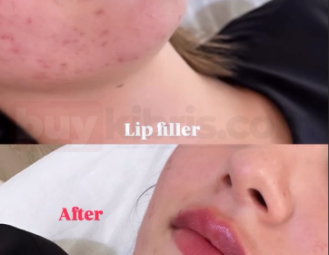 Doğal Dudak Dolgusu ile Canlı Görünüm