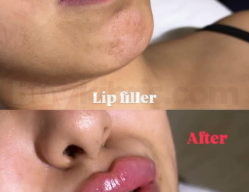 Belirgin Kontur ve Dolgun Dudaklar