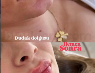 Anında Etkili Dudak Dolgusu