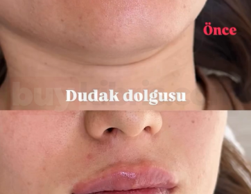 Doğal ve Dengeli Dudak Dolgusu