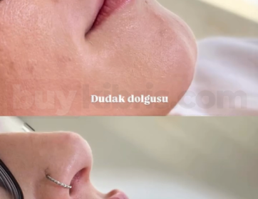 Profilde Doğal Dudak Dolgunluğu