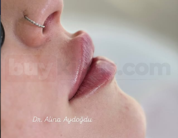 Profilde Belirgin Dudak Formu