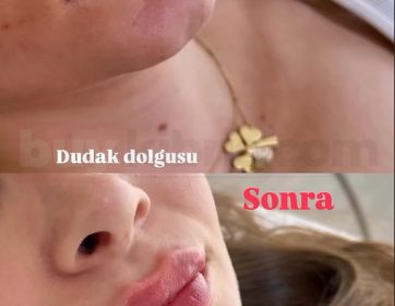 Yumuşak Geçişli Dudak Dolgusu