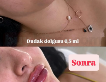 0.5 ml Doğal Dudak Dolgusu