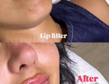 Canlı ve Parlak Dudak Dolgusu