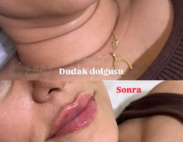 Doğal ve Yumuşak Dudak Dolgunluğu