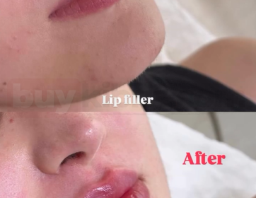 Belirgin ve Canlı Dudak Dolgusu