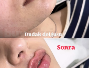 Doğal ve Hacimli Dudak Dolgusu