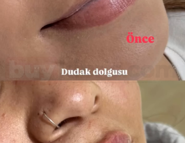 Kontur Düzeltme ve Dudak Yenileme