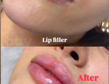 Dolgun ve Doğal Dudak Hatları