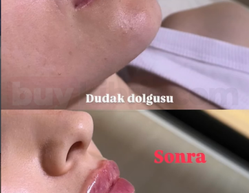 Doğal Profil ve Dudak Dolgunluğu