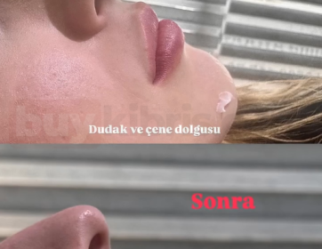 Dudak ve Çene ile Profil Dengeleme